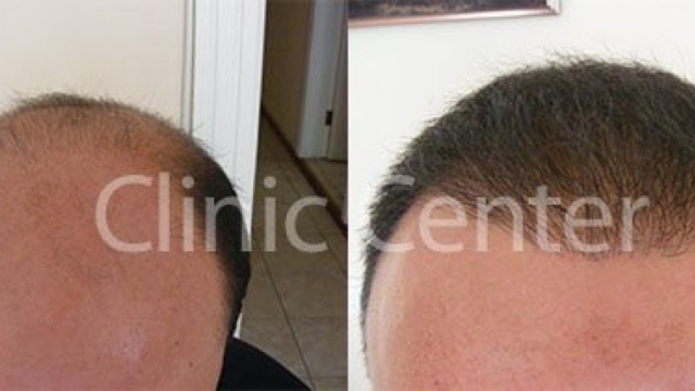 Revitalizing Your Hairline: Unveiling the Secrets of Hair Implants