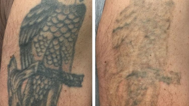 Tattoo Removal – Possess To Options