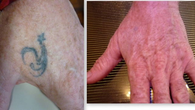 Tca Tattoo Removal – Guaranteed Remove Any & All Forms Of Tattoos