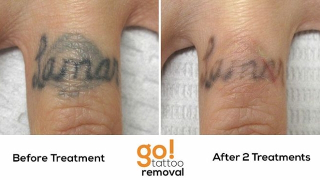 Bad Tattoos Are Increasing – Can Tattoo Removal