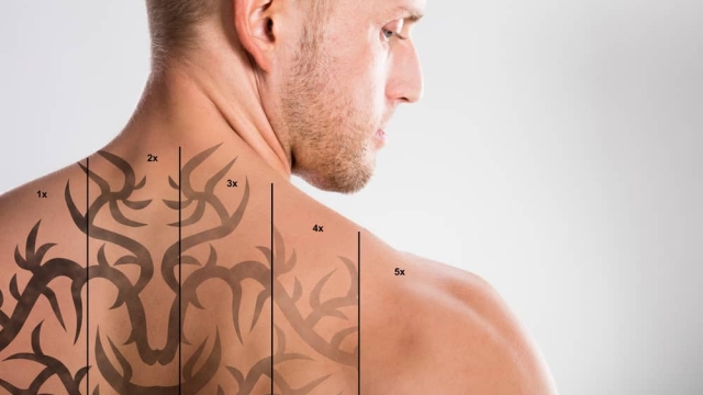 Everything About Tattoo Removal